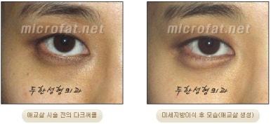 두한성형외과 눈밑성형 - 애교필러 후 눈밑재수술 관련 이미지 42