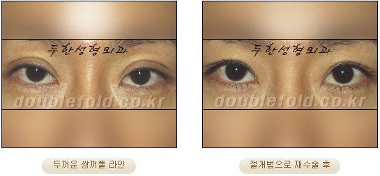 [Duhan Plastic Surgery Double Eyelid Revision Surgery] - [Ptosis Correction Surgery] image 42