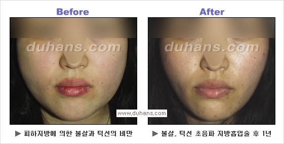 [두한성형외과 경쟁력 얼굴지방흡입] - [통통한 볼살, 두툼한 턱살(턱선)의 지방흡입] 관련 이미지 13