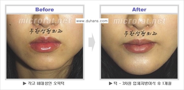 [두한성형외과 NO 1. "Col-fat 지방이식"] - [지방이식의 지속효과, 오해와 진실, 부작용] 관련 이미지 12