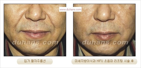 [두한성형외과 경쟁력 주름성형] - [주름제거를 위한 리프팅] 관련 이미지 57