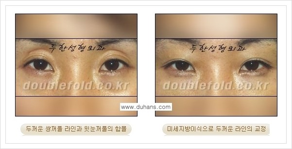 [두한성형외과 경쟁력 눈성형] - [미세지방이식으로 두껍고 어색한 라인 교정 안내 1.] 관련 이미지 5