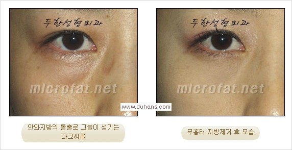[두한성형외과 경쟁력 눈밑성형] - [과도한 눈밑지방제거의 부작용 후 눈밑지방재배치] 관련 이미지 21