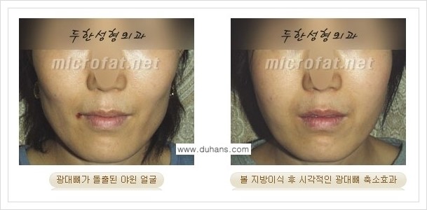 [두한성형외과 경쟁력 미세지방이식] - [볼살 지방이식 - 광대뼈 돌출, 사각턱] 관련 이미지 1
