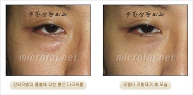 두한성형외과 눈밑수술 - 다크서클 수술 전후 관리 안내 관련 이미지 79