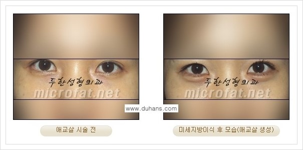 [두한성형외과 경쟁력 눈밑성형] - [눈밑 다크써클과 눈밑 애교살과의 관계] 관련 이미지 9