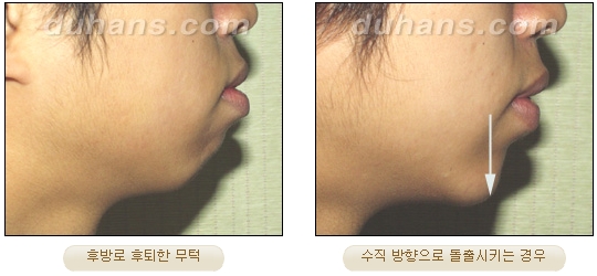 [Duhan Plastic Surgery Micro Fat Grafting] - [Receded Chin, Small Chin, Cleft Chin, Chin Line Asymmetry Correction] image 3