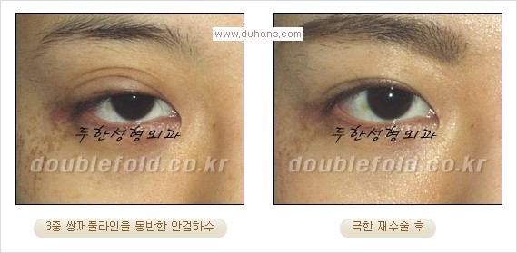 [두한성형외과 경쟁력 쌍꺼풀 재수술, 극한 재수술]- [쌍꺼풀 재수술의 성공 조건(Condition of successful reoperation) 관련 이미지 15