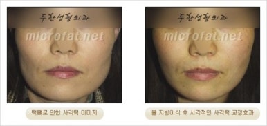 [두한성형외과 얼굴자가지방이식] - [지방이식 과정] 관련 이미지 39