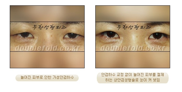 과교정 눈매 (소세지 쌍커풀 재수술, 눈매교정 재수술) 관련 이미지 11