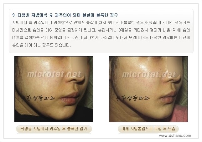 [두한성형외과 경쟁력 볼살지방이식] - [타병원 지방이식 후 - 굴곡이 발생한 경우, 과주입으로 인해 볼살이 불룩한 경우 안내] 관련 이미지 8