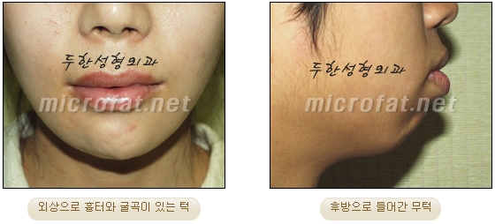 [두한성형외과 미세지방이식] - [무턱교정 안내] 관련 이미지 4