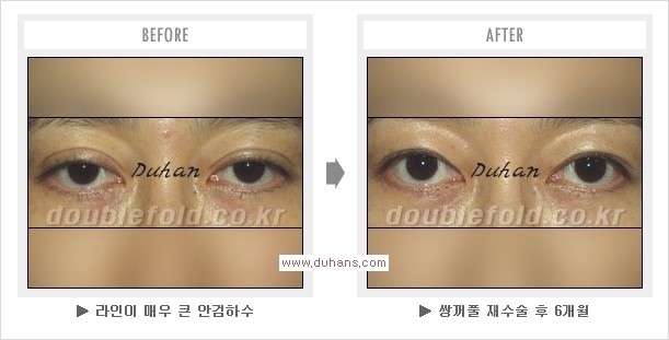 ​[두한성형외과 경쟁력 쌍꺼풀 재수술] - [아름다운 쌍꺼풀 선의 기준과 쌍꺼풀 재수술시 검사와 테스트 안내] 관련 이미지 15