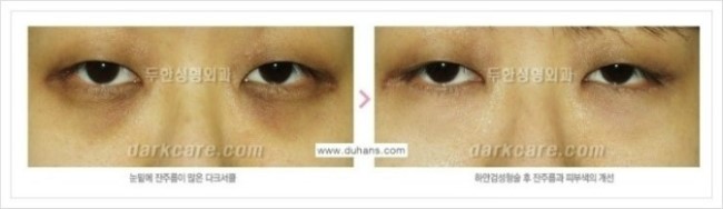 [두한성형외과 경쟁력 눈밑성형] - [여러 가지 다양한 다크써클 증상과 맞춤 치료 방법] 관련 이미지 23