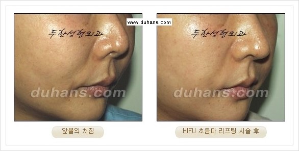 [두한성형외과 경쟁력 주름성형] - [HIFU 초음파 리프팅 주름교정술 안내 2.] 관련 이미지 16