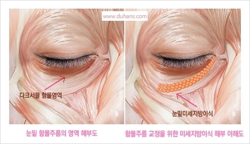 [두한성형외과 경쟁력 눈밑성형] - [눈밑 미세지방이식의 이해도 안내] 관련 이미지 14
