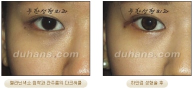 Blepharoplasty, Duhan Plastic Surgery - Upper and Lower Eyelids image 43
