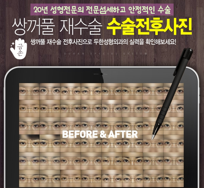 두한성형외과 몽고주름 제거 관련 이미지 12