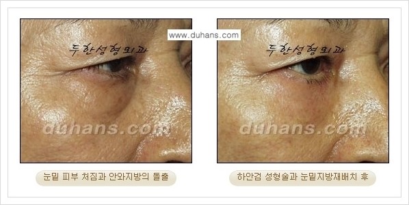 [두한성형외과 경쟁력 눈성형] - [젊은 눈매로의 복원 안검성형] 관련 이미지 29