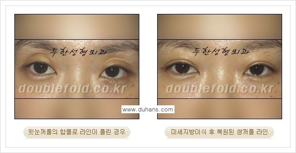 [두한성형외과 경쟁력 쌍꺼풀 재수술(극한 재수술)] - [라인이 풀렸을 경우의 쌍꺼풀 재수술 안내 ②] 관련 이미지 10