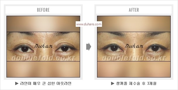[두한성형외과 경쟁력 눈성형] - [나에게 맞는 어울리는 쌍꺼풀 라인] 관련 이미지 14