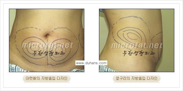 [두한성형외과 경쟁력 맞춤 바디성형] - [간편한 아랫배, 윗배, 허리, 옆구리살, 허벅지, 엉덩이, 복부지방흡입술, 팔뚝(상완부) 지방흡입술 안내] 관련 이미지 3