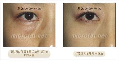 두한성형외과 눈밑수술 - 다크서클 수술 전후 관리 안내 관련 이미지 77