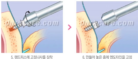 Duhan Plastic Surgery Combo Program - Dark Circles and Lifting image 34