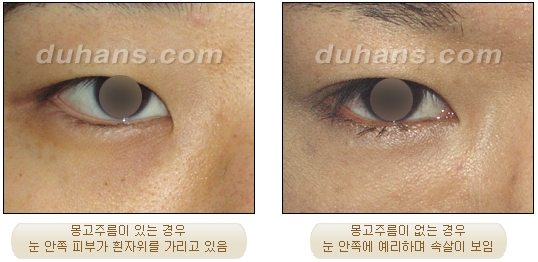 쌍커풀수술 두한성형외과 - 나에게 맞는 눈성형은? 관련 이미지 48