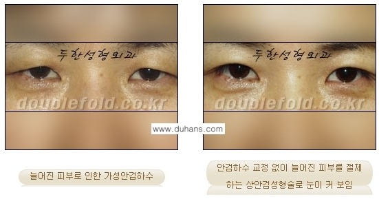 [두한성형외과 경쟁력 눈성형] - [안검하수(졸리운 눈매)의 종류와 교정 방법 안내] 관련 이미지 9