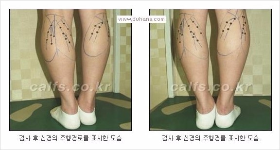 [두한성형외과 Dr. 컬럼 - 타 병원의 종아리 퇴축술 이후 문제가 발생한 경우] 관련 이미지 5