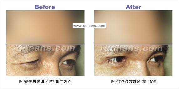 [두한성형외과 NO.1 눈성형] - [상안검 수술에 대한 정보] 관련 이미지 6