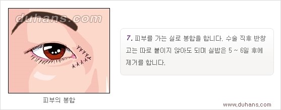 [두한성형외과 경쟁력 눈성형] - [흉터없는 몽고주름 제거 - 앞트임 수술 안내] 관련 이미지 15