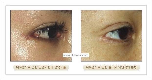 [두한성형외과 경쟁력 쌍꺼풀 재수술, 극한 눈재수술] - [뒤트임 부작용과 뒤트임 교정수술 방법 안내] 관련 이미지 10