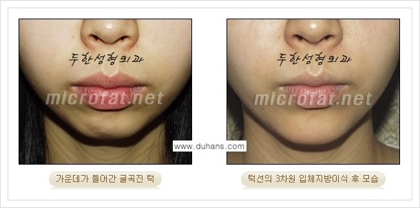 [두한성형외과 경쟁력 안면윤곽 교정] - [미세지방이식으로 무턱, 작은턱, 오목턱, 턱선의 비대칭 교정 안내] 관련 이미지 14