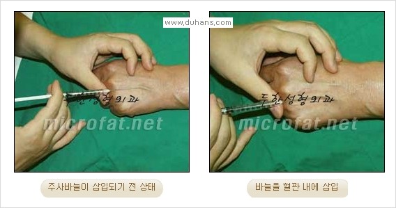 [두한성형외과 경쟁력 정맥류 치료] - [손, 손등, 손목혈관확장증, 팔혈관확장증에 질문과 답변] 관련 이미지 4