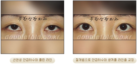 [Duhan Plastic Surgery Secondary Double Eyelid Surgery] - [Sleepy Eye Appearance, Asymmetrical Eye Appearance, Ptosis] image 16