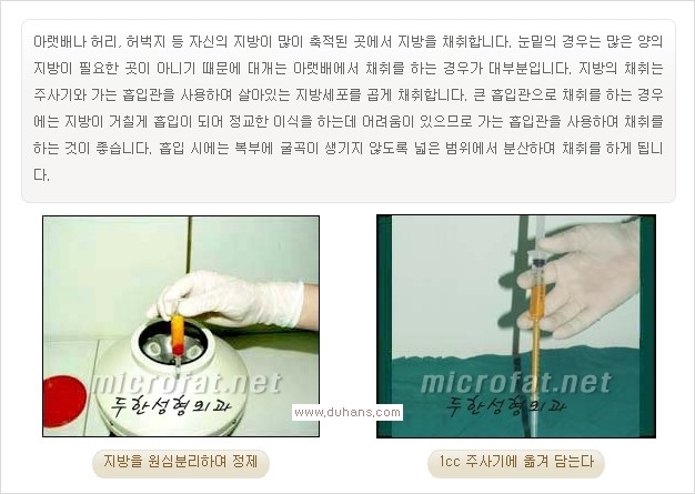 [두한성형외과 경쟁력 눈밑성형] - [눈밑이 전반적으로 함몰된 다크써클 교정 안내] 관련 이미지 2