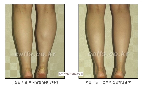 ⁠[두한성형외과 경쟁력 종아리성형] - [종아리퇴축술 - 비절개 초음파 유도 선택적 신경차단술 장비 안내] 관련 이미지 7