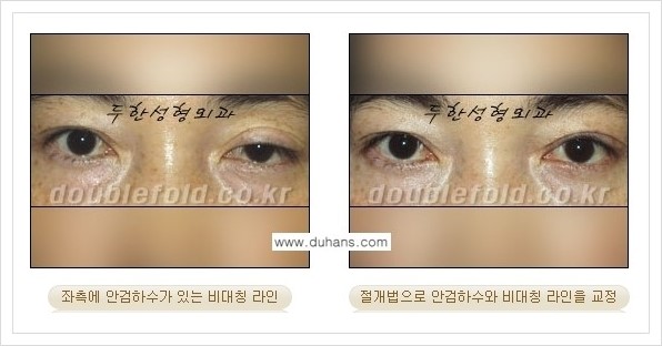[두한성형외과 경쟁력 쌍꺼풀 재수술, 극한 눈 재수술] - [안검하수(졸리운 눈매) 재수술 안내] 관련 이미지 10