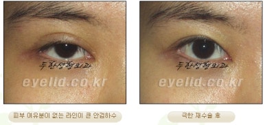 Duhan Plastic Surgery Ophthalmic Reoperation - What Is a Successful Double Eyelid Revision Surgery? image 26