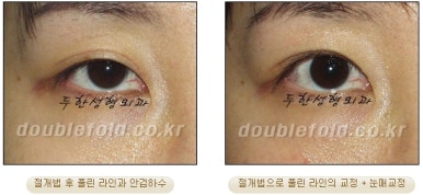 Double Eyelid Revision Surgery at Duhan Plastic Surgery Clinic - Asymmetric Double Eyelids, Pseudoptosis, and Lateral/Lower Canthoplasty image 34