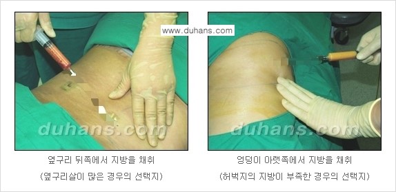 [두한성형외과 NO.1 지방이식]-[두한 지방이식 클리닉의 특징] 관련 이미지 7