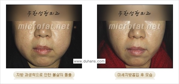 ​​​​[두한성형외과 경쟁력 미세지방이식] - [지방이식 부작용 - 지방이식 과다주입, 과다생착의 얼굴 모양에 대한 안내] 관련 이미지 3