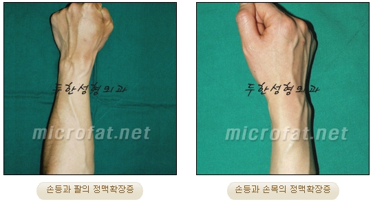 [Duhan Plastic Surgery Clinic Varicose Veins] - [Hand and Arm Venous Dilation] image 3