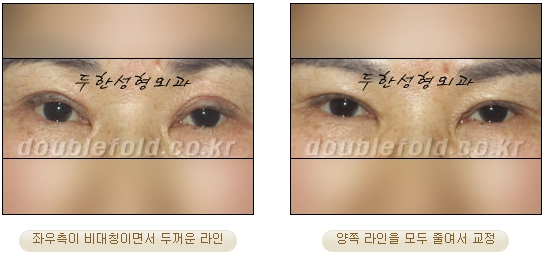 [두한성형외과 쌍커풀수술] - [눈성형 방법에 대한 자주하는 질문과 답변] 관련 이미지 38