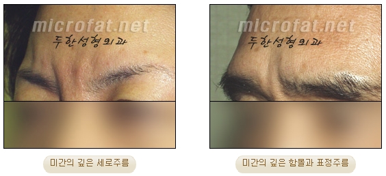 Duhan Plastic Surgery Wrinkle Improvement - Glabellar Horizontal Wrinkles, Glabellar Straight Wrinkles, Glabellar Wrinkle Surgery image 2