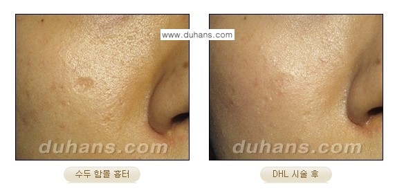 [두한성형외과 흉터 교정] - [함몰흉터의 DHC 시술] 관련 이미지 13