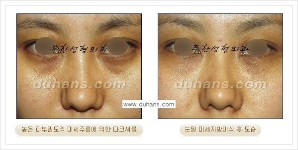 [두한성형외과 경쟁력 눈밑성형] - [꺼진 눈밑, 눈밑 함몰 주름선 눈밑 미세지방이식 안내] 관련 이미지 21