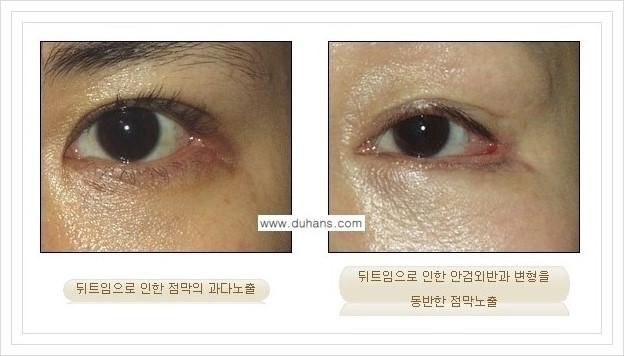 [두한성형외과 경쟁력 쌍꺼풀 재수술, 극한 눈재수술] - [뒤트임 부작용과 뒤트임 교정수술 방법 안내] 관련 이미지 3